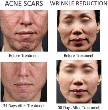 two handle RF Microneedle skin rejuvenation scan scar pigment removal machine