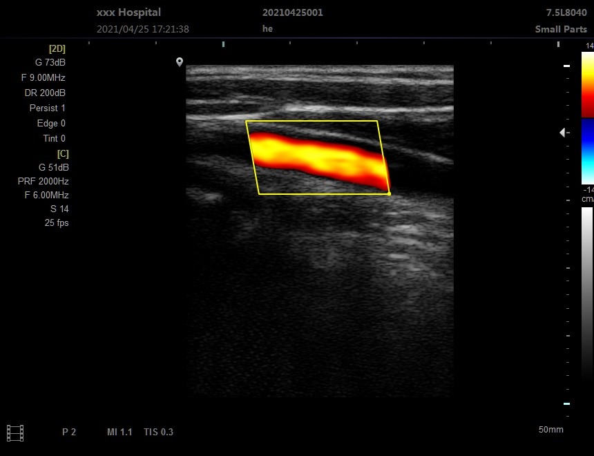 ISO Basic Level Portable USG Machine Digital Color Doppler Ultrasound System