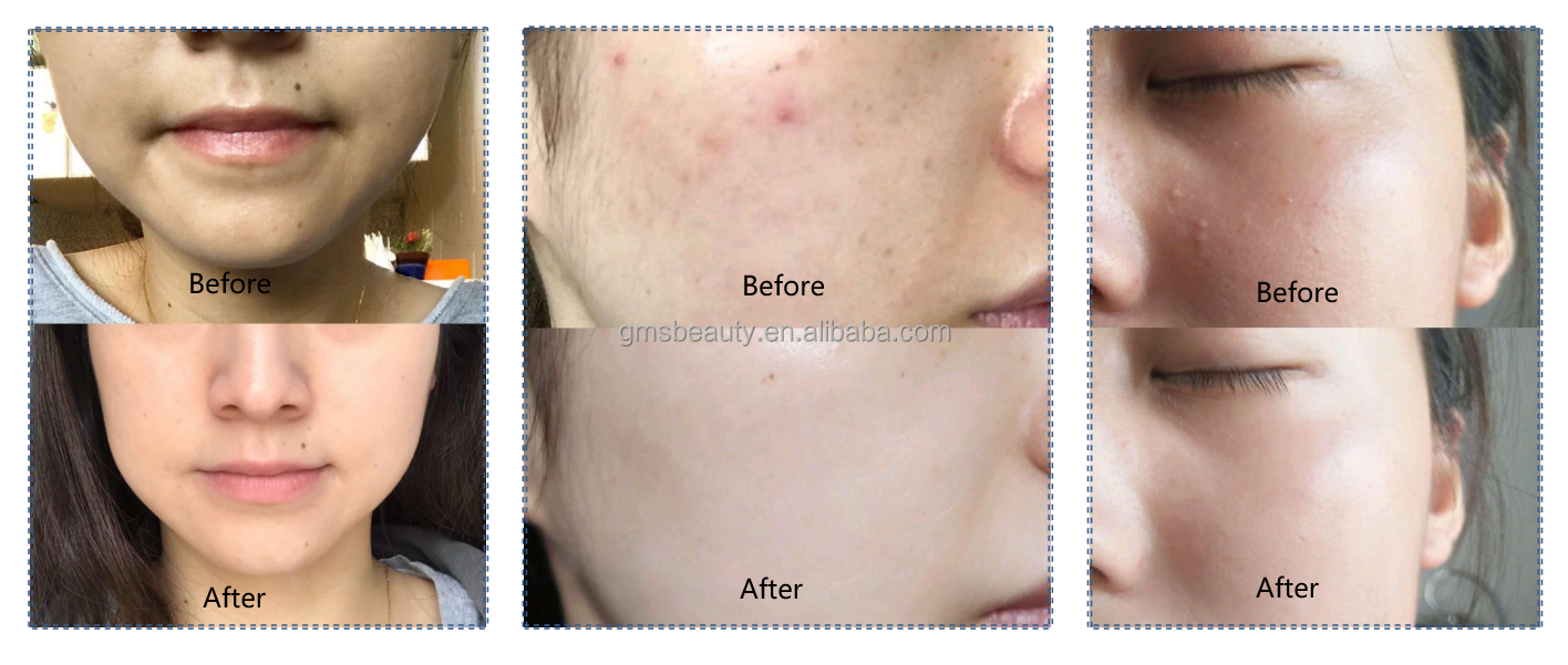 portable-opt-hair-removal-ipl-machine-face-acne-treatment-wrink-skin-rejuvenation-acne-clearance-portable-ipl-m22-beauty-machine