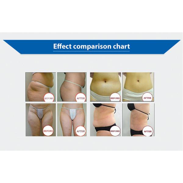 Renlang OEM Portable Fat Freezing Machine Cryo Sculpting Machine