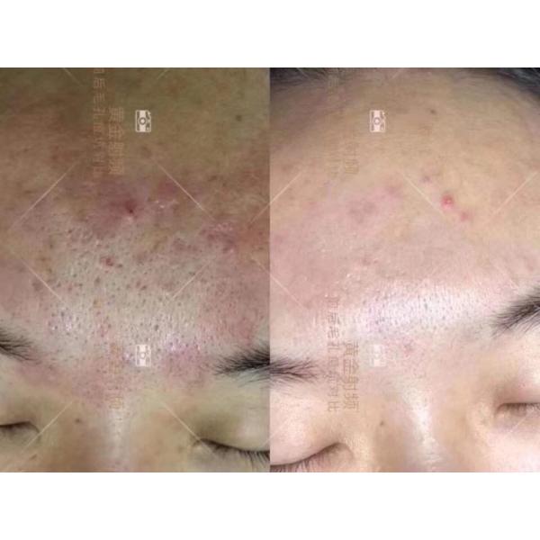 two handle RF Microneedle skin rejuvenation scan scar pigment removal machine