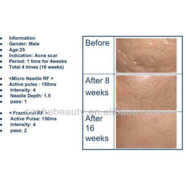 skin lifting machine fractional micro needles RF