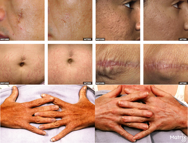 Hot selling face treatment 10.4 inch 1000w input power 40 watt co2 erbium fractional skin laser resurfacing machine
