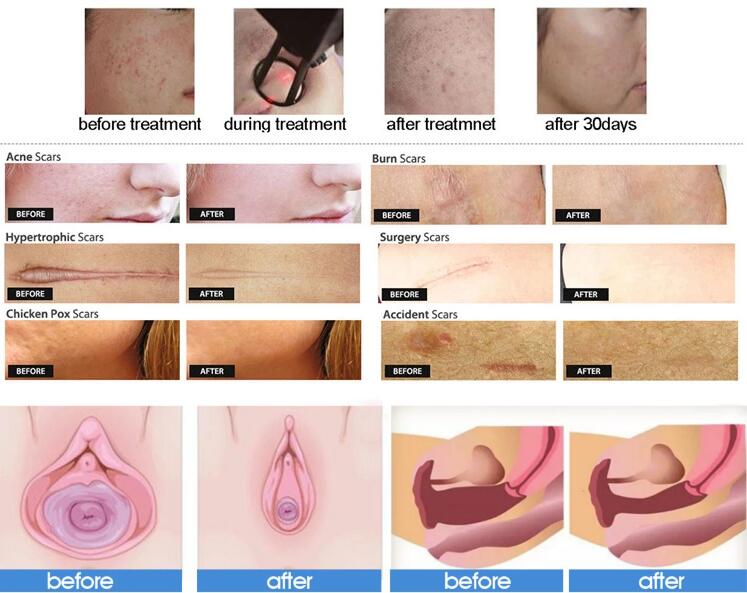 Fractional CO2 Laser Skin Resurfacing Machine 50W For Acne Treatment / Scar Removal