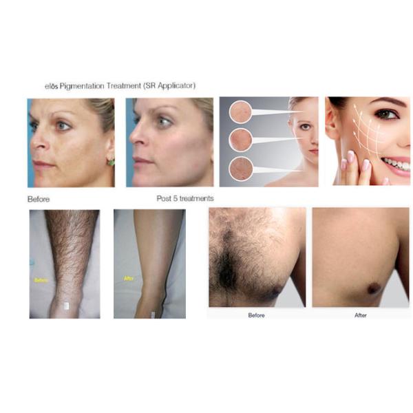 Vertical E Light Laser Hair Removal Machine Remove Vascular And Improve Face Redness
