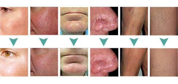 pigment skin tag spider vein removal machine for leg face in salon