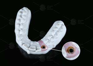 Best Internal Hex Custom Titanium Abutment Screw Cement Retained Varying Shape wholesale