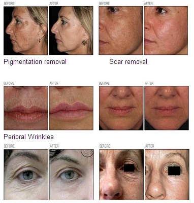 rf driver fractional co2 laser acne and stretch marks removal