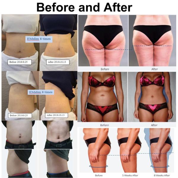 Powerful EMS Body Sculpting Machine , Magnetic Muscle Stimulator Pulsation 300us 5000w