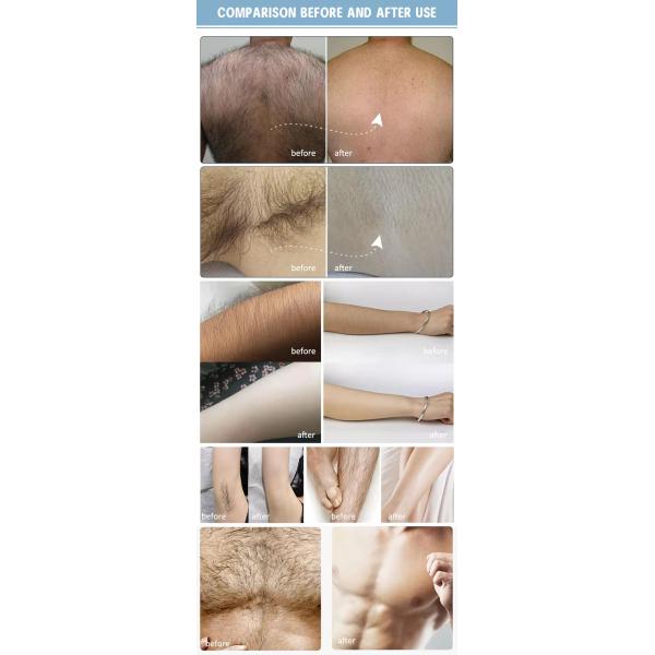 Triple Wavelength Laser Hair Removal Machine 755nm 808nm 1064nm With Wind Cooling System