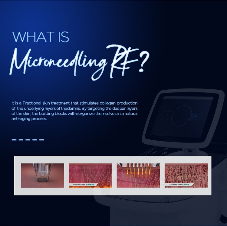 Needle RF Machine Fractional RF Machine For Scar Acne Treatment Fractional Microneedle RF