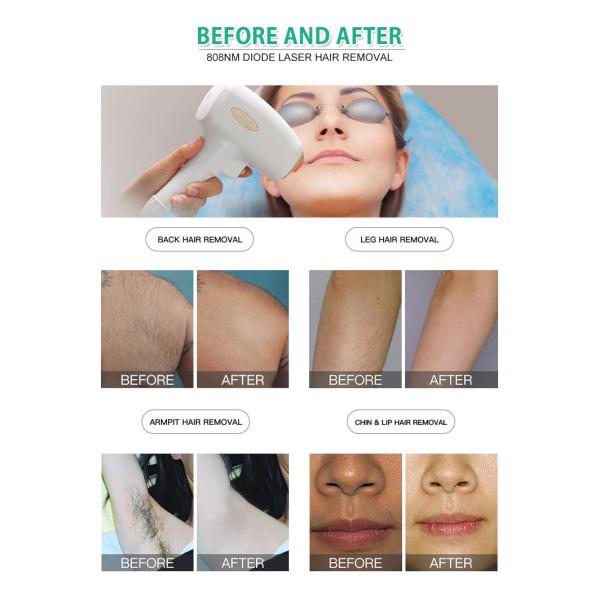 Super 808 Laser Clinic Pain Free Hair Removal Machine ISO CE Approval