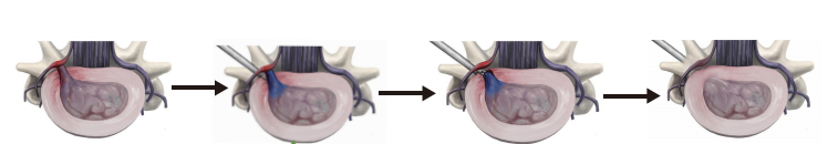 Hemispherical Plasma Spine Probe for Intervertebral Foramen Endoscope