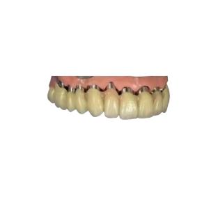 China CAD CAM PFM Implant Crown Bridge Telescopic Crown Dental 3D Printed Models on sale