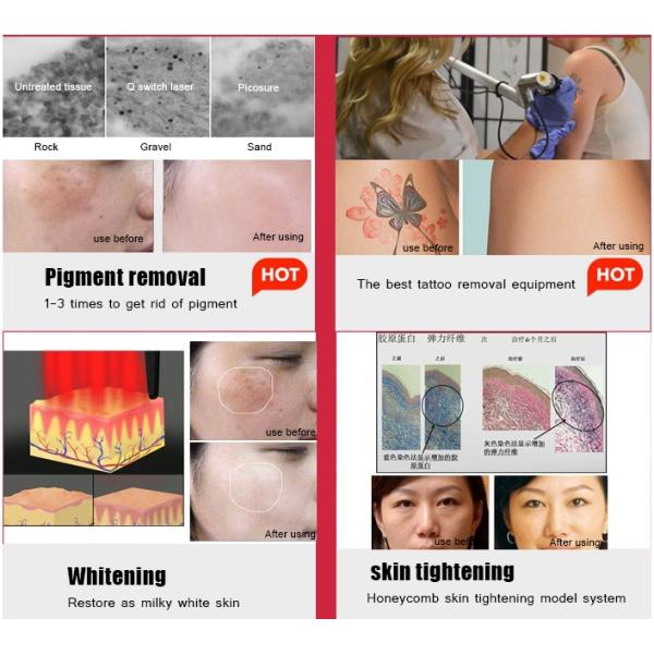 10.4 Inch Screen 2000W nd yag laser Nd Yag Tattoo Removal Machine