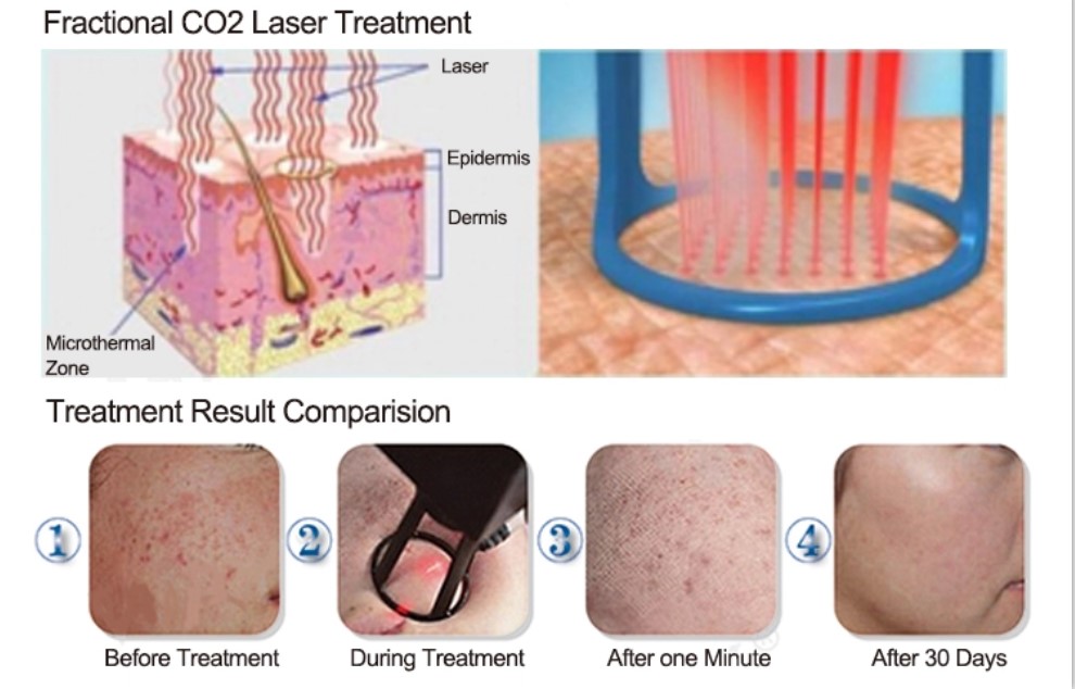 Fractional CO2 Laser Skin Resurfacing Machine 50W For Acne Treatment / Scar Removal