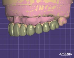 Best HIPAA Compliant Data Security Digital Wax Up 3D Model For Dental Modifications wholesale