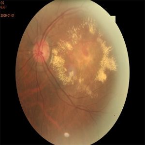 Automated Retinal Fundus Camera Non Contact High Resolution