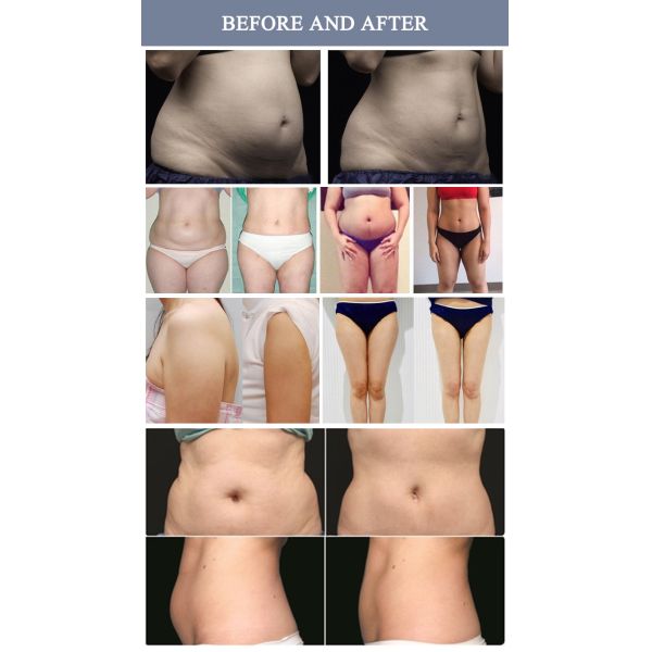 Shaping FDA Approved Laser Lipo Sculpt Machine Auto Mode / Manual Mode