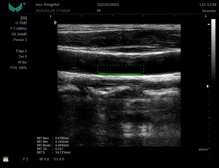 ISO Basic Level Portable USG Machine Digital Color Doppler Ultrasound System