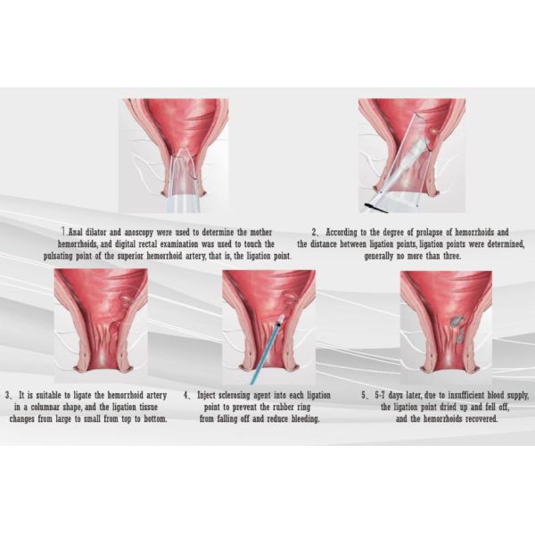 Anorectal Ligator Disposable Surgical Stapler Hemorrhoidectomy Stapler